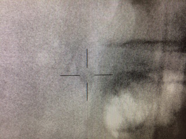 An xray for an example of crosshair of Extracorporeal Shock Wave Lithotripsy.