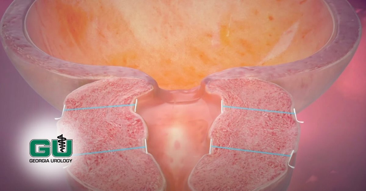 Illustration of Urolift procedure of the prostate gland