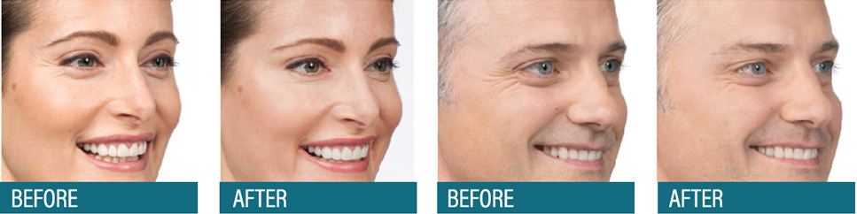Aesthetic Center Botox – Wrinkle Reduction
