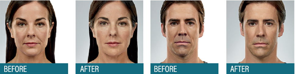 Aesthetic Center Facial Fillers – Wrinkle Reduction