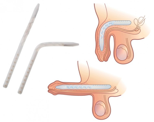 Genesis Flexible Rod Penile Implant