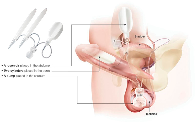 Titan Touch Inflatable Penile Implant diagram pointing out 1. A reservoir in the abdomen; 2. Two cylinders placed in the penis; 3. A pump placed in the scrotum